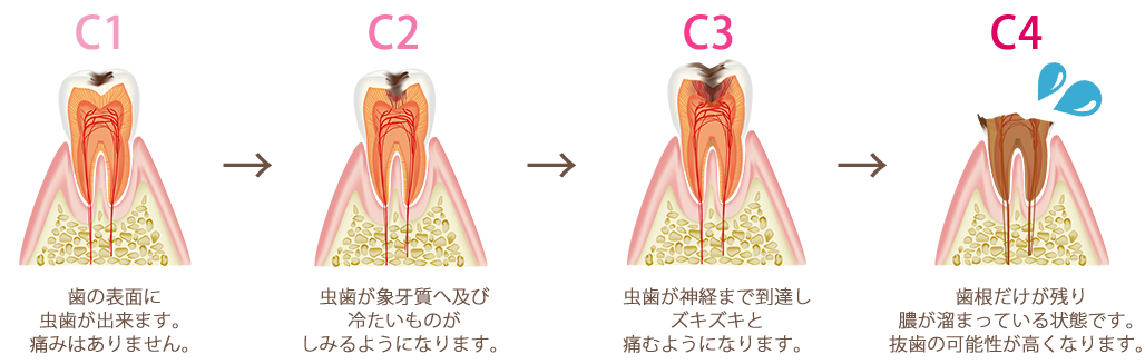 むし歯の進行について