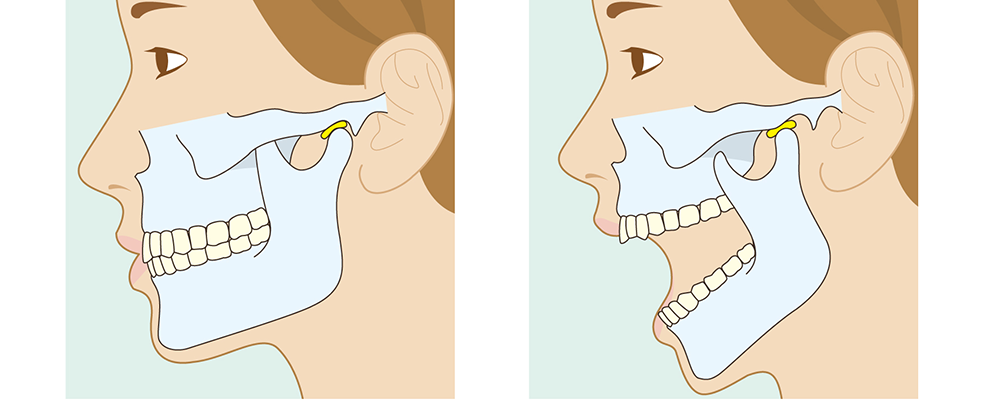 顎関節症