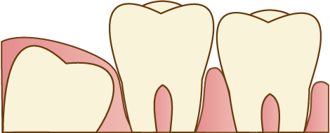 親知らずの抜歯