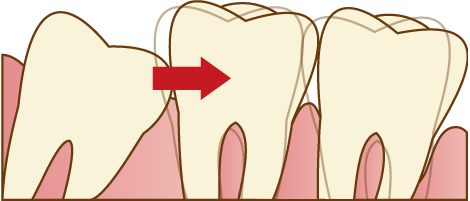 歯並びに直接影響する場合