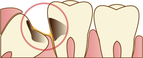隣接する歯に悪影響を及ぼしている