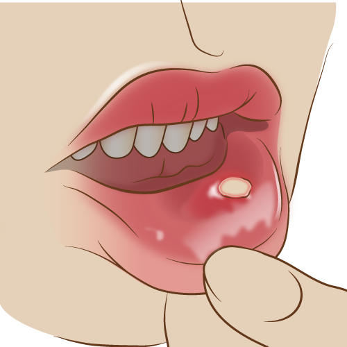 「口内炎」の原因は細菌による炎症